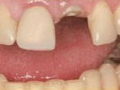 Implants Before