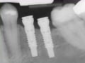 Implants