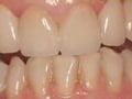 Implants After