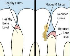 Gum Disease Graphic