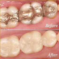 Crowns - Before & After