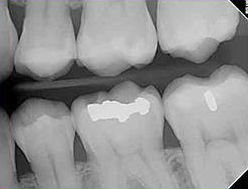 Dental X-ray